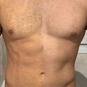 depilación láser en Las Franqueses del Vallés